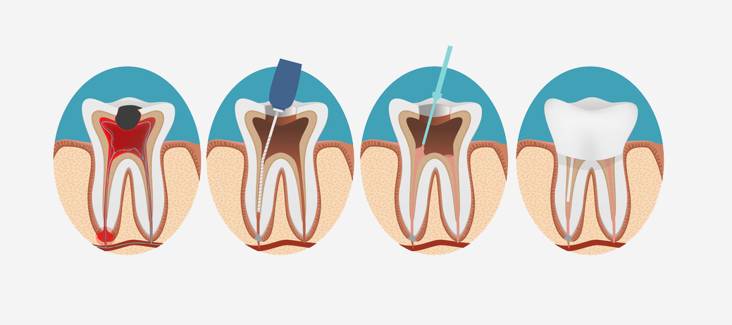 Procedura leczenia endodontycznego (kanałowego)